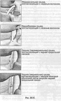 Победить боль в спине Победить боль в спине