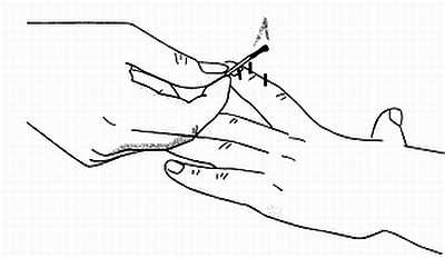 Сам себе Су Джок доктор